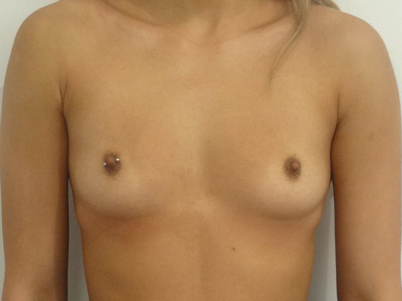 Breast Augmentation Before & After Gallery - Patient 449857 - Image 1
