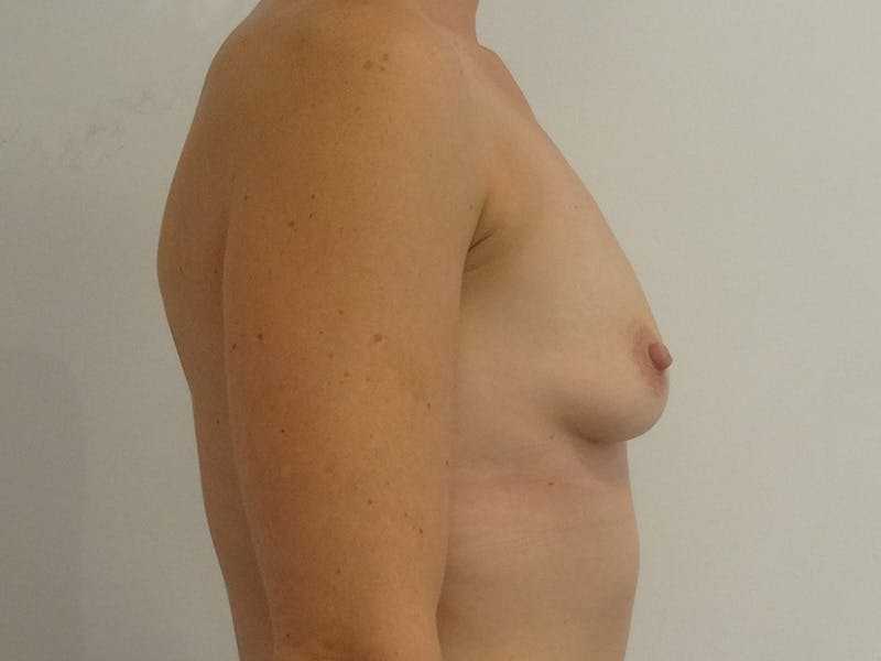 Breast Augmentation Before & After Gallery - Patient 427460 - Image 5