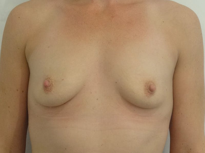 Breast Augmentation Before & After Gallery - Patient 427460 - Image 1