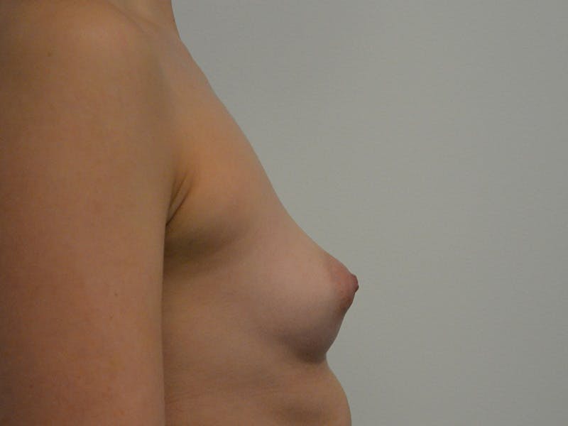 Breast Augmentation Before & After Gallery - Patient 850496 - Image 5