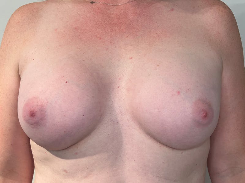 Breast Augmentation Before & After Gallery - Patient 939335 - Image 2