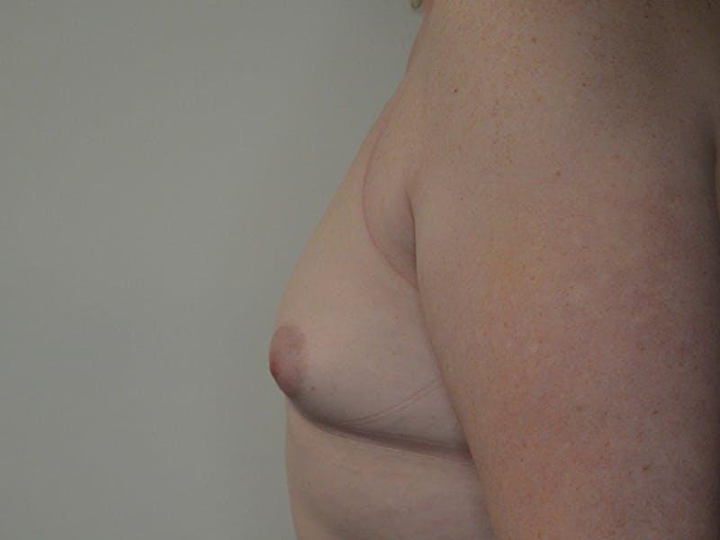 Breast Augmentation Before & After Gallery - Patient 939335 - Image 5