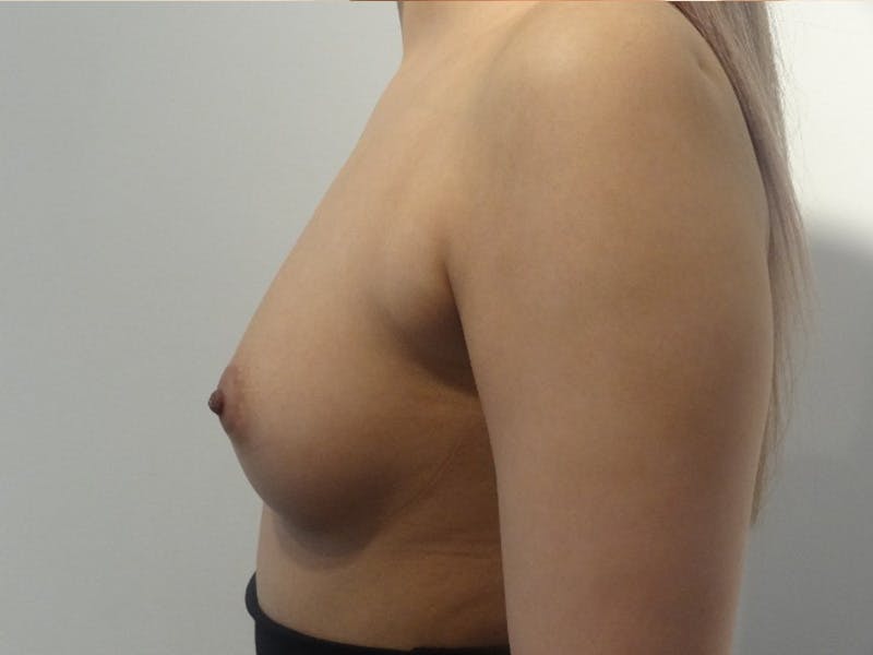 Breast Augmentation Before & After Gallery - Patient 385515 - Image 5