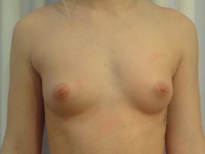 Breast Augmentation Before & After Gallery - Patient 405883 - Image 1