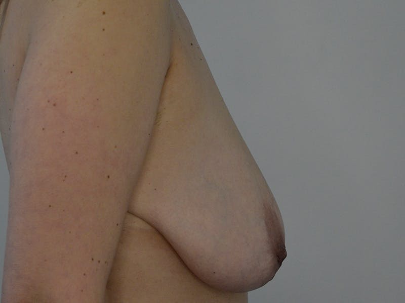 Breast Augmentation and Lift Before & After Gallery - Patient 277594 - Image 5