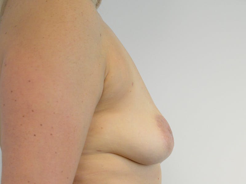 Breast Augmentation and Lift Before & After Gallery - Patient 137997 - Image 5