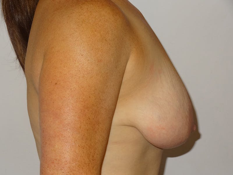 Breast Augmentation and Lift Before & After Gallery - Patient 180926 - Image 5