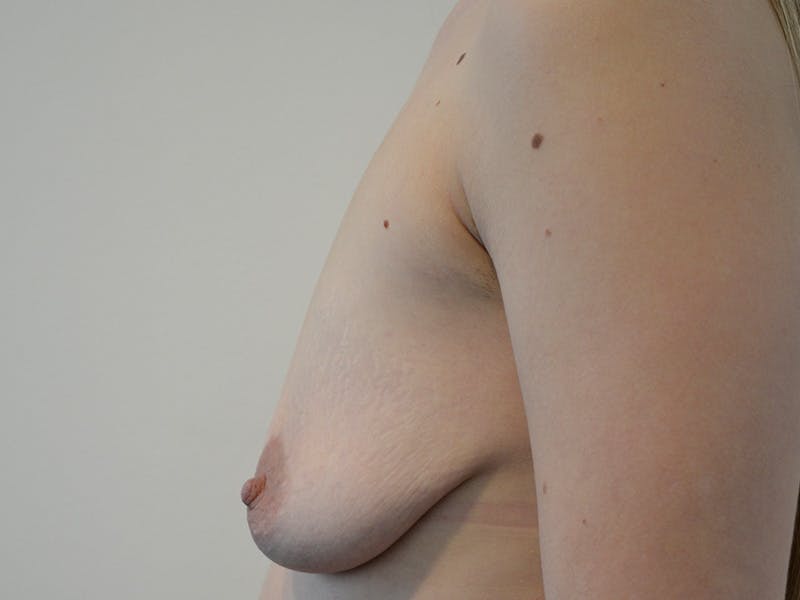 Breast Augmentation and Lift Before & After Gallery - Patient 151972 - Image 5