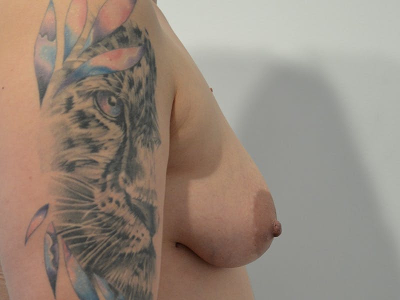 Breast Augmentation and Lift Before & After Gallery - Patient 153586 - Image 5