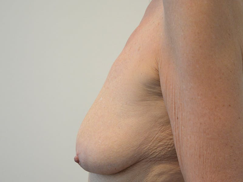Breast Augmentation and Lift Before & After Gallery - Patient 727375 - Image 5