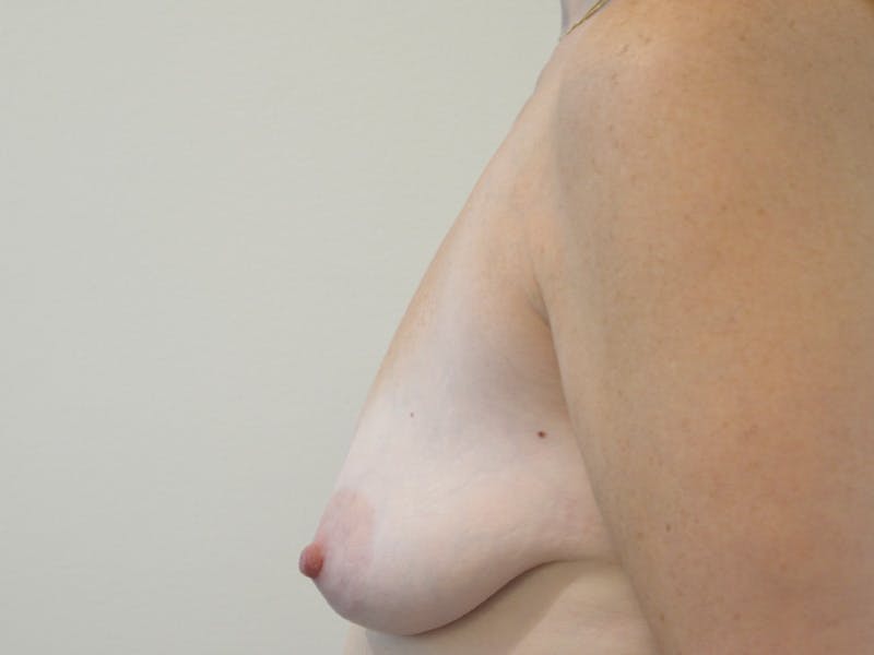 Breast Augmentation and Lift Before & After Gallery - Patient 354760 - Image 3