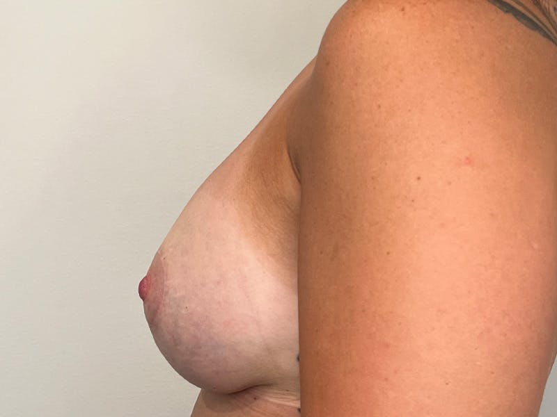 Breast Augmentation and Lift Before & After Gallery - Patient 159744 - Image 6