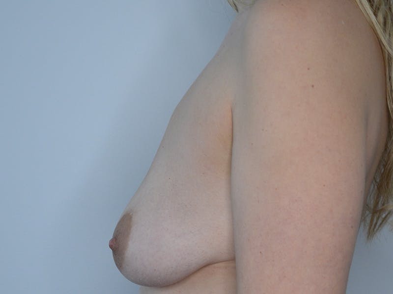 Breast Augmentation and Lift Before & After Gallery - Patient 774904 - Image 5