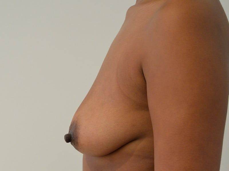 Breast Augmentation and Lift Before & After Gallery - Patient 788443 - Image 5