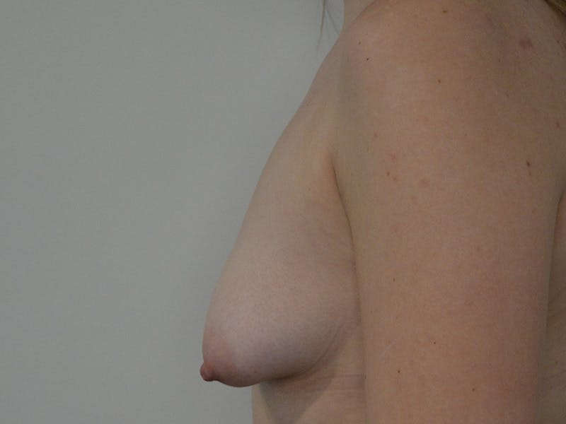 Breast Augmentation and Lift Before & After Gallery - Patient 225981 - Image 5