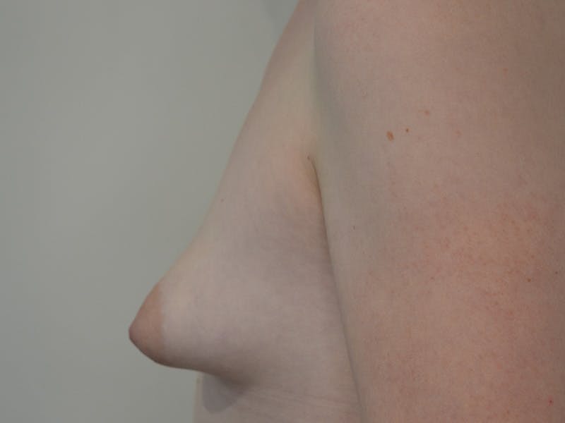 Breast Augmentation and Lift Before & After Gallery - Patient 187902 - Image 5
