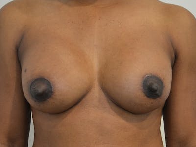 Breast Augmentation and Lift Before & After Gallery - Patient 252241 - Image 2