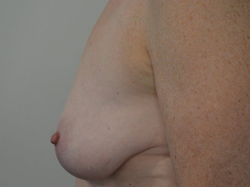 Breast Lift Before & After Gallery - Patient 138358 - Image 5