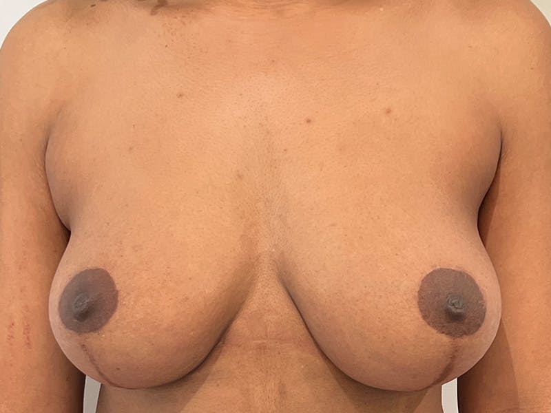 Breast Lift Before & After Gallery - Patient 915674 - Image 2