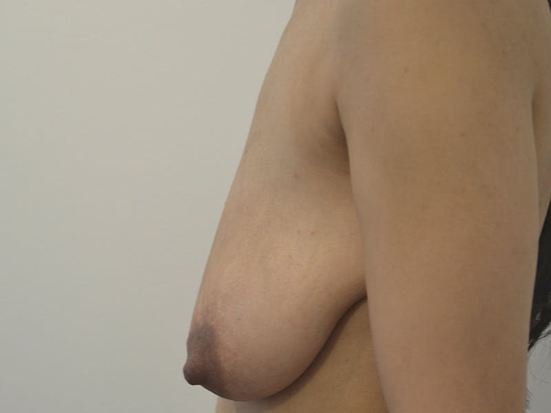 Breast Lift Before & After Gallery - Patient 951900 - Image 5