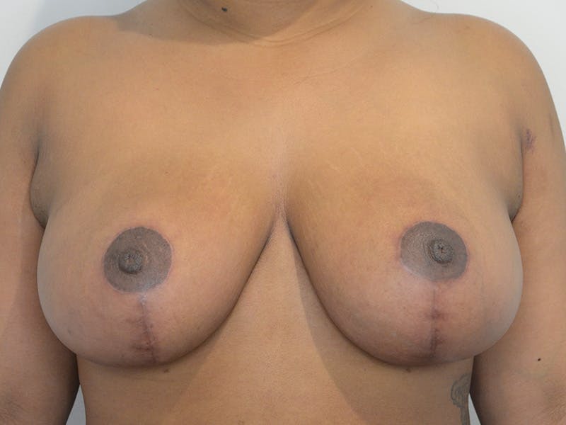 Breast Reduction Before & After Gallery - Patient 240702 - Image 2