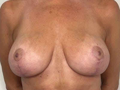 Breast Reduction Before & After Gallery - Patient 187694 - Image 2