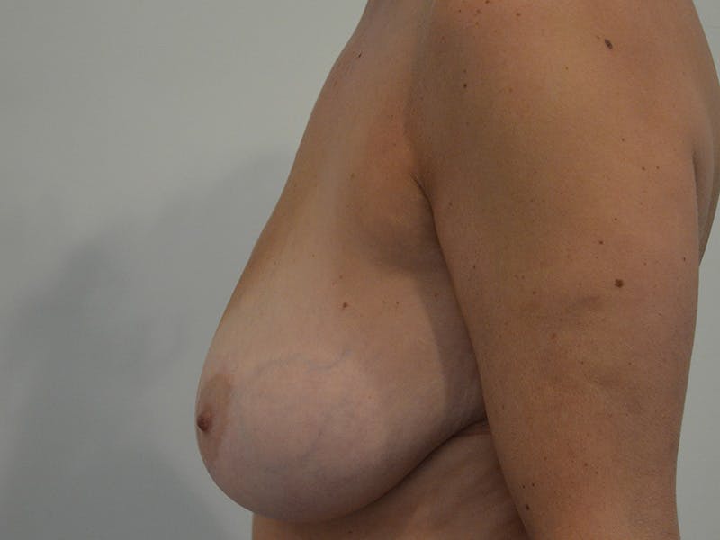 Breast Reduction Before & After Gallery - Patient 187694 - Image 5