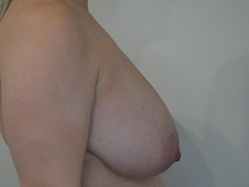 Breast Reduction Before & After Gallery - Patient 305183 - Image 4