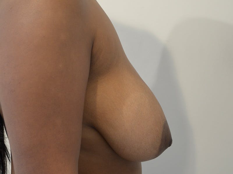 Breast Reduction Before & After Gallery - Patient 874025 - Image 5