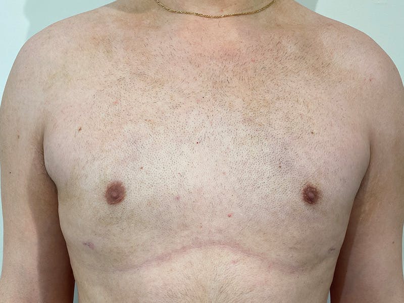 Gynecomastia Before & After Gallery - Patient 258735 - Image 2
