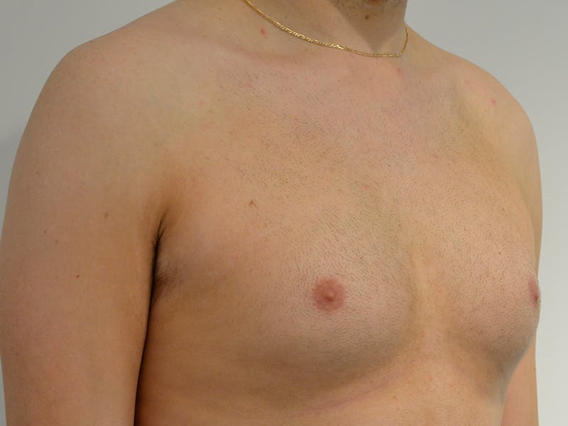 Gynecomastia Before & After Gallery - Patient 258735 - Image 3