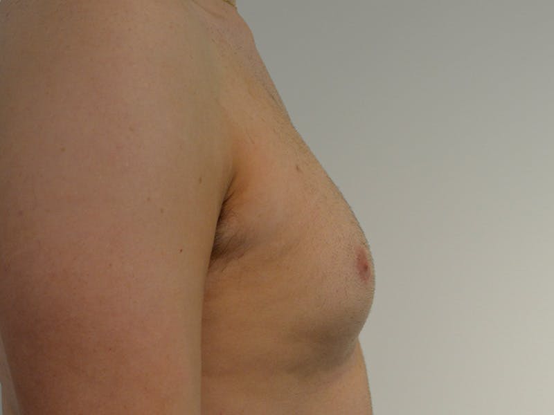 Gynecomastia Before & After Gallery - Patient 258735 - Image 5