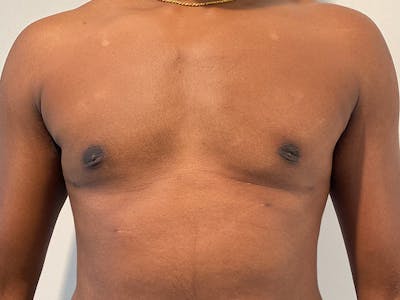 Gynecomastia Before & After Gallery - Patient 324113 - Image 2