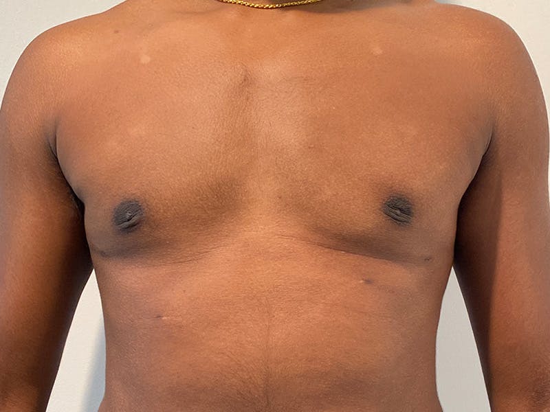 Gynecomastia Before & After Gallery - Patient 324113 - Image 2