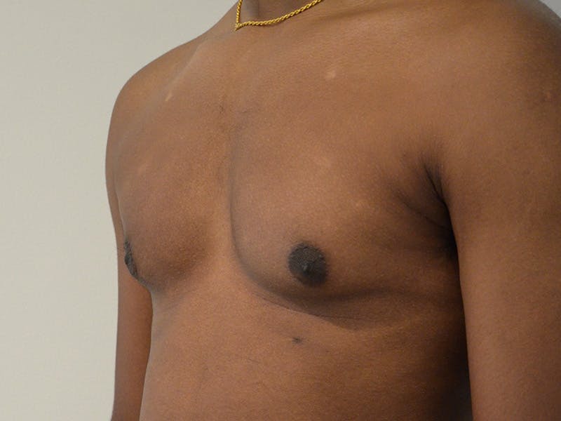 Gynecomastia Before & After Gallery - Patient 324113 - Image 3