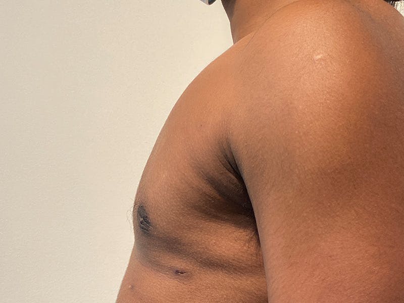 Gynecomastia Before & After Gallery - Patient 324113 - Image 6