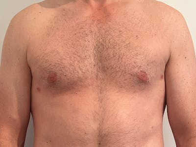 Gynecomastia Before & After Gallery - Patient 275111 - Image 2