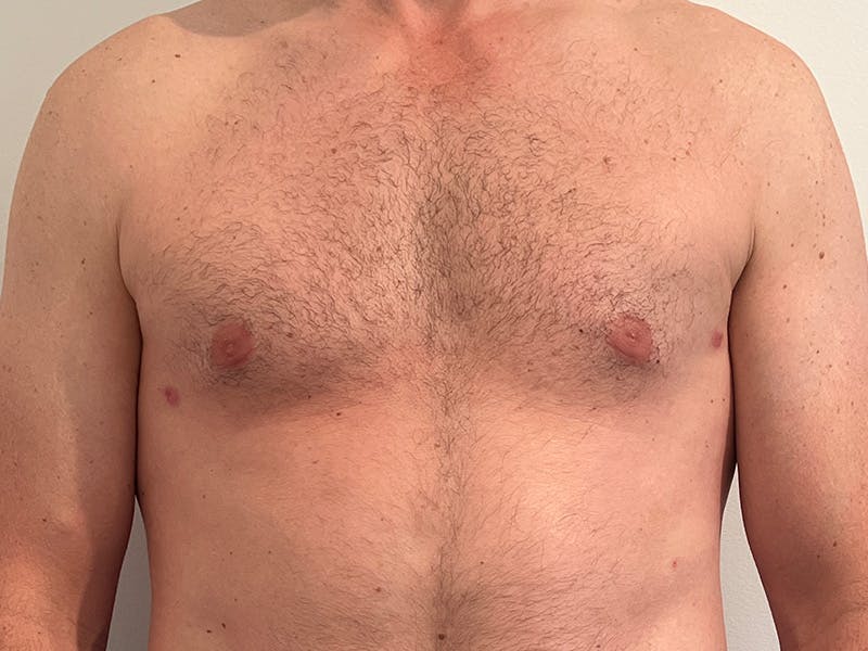 Gynecomastia Before & After Gallery - Patient 275111 - Image 2