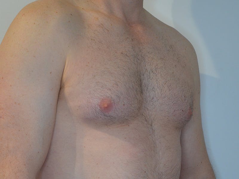 Gynecomastia Before & After Gallery - Patient 275111 - Image 3