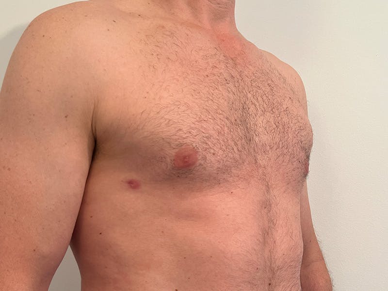 Gynecomastia Before & After Gallery - Patient 275111 - Image 4