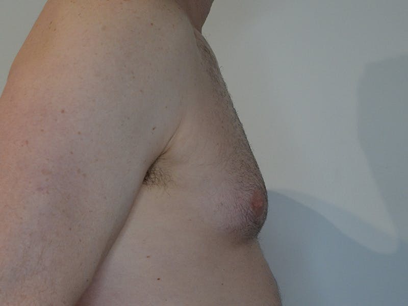 Gynecomastia Before & After Gallery - Patient 275111 - Image 5