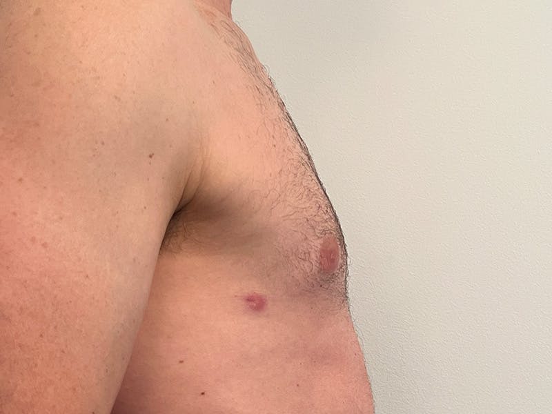 Gynecomastia Before & After Gallery - Patient 275111 - Image 6