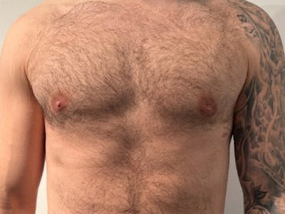 Gynecomastia Before & After Gallery - Patient 396674 - Image 2