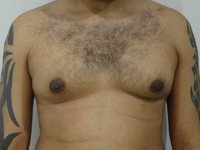 Gynecomastia Before & After Gallery - Patient 395307 - Image 1