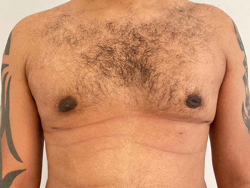 Gynecomastia Before & After Gallery - Patient 395307 - Image 2