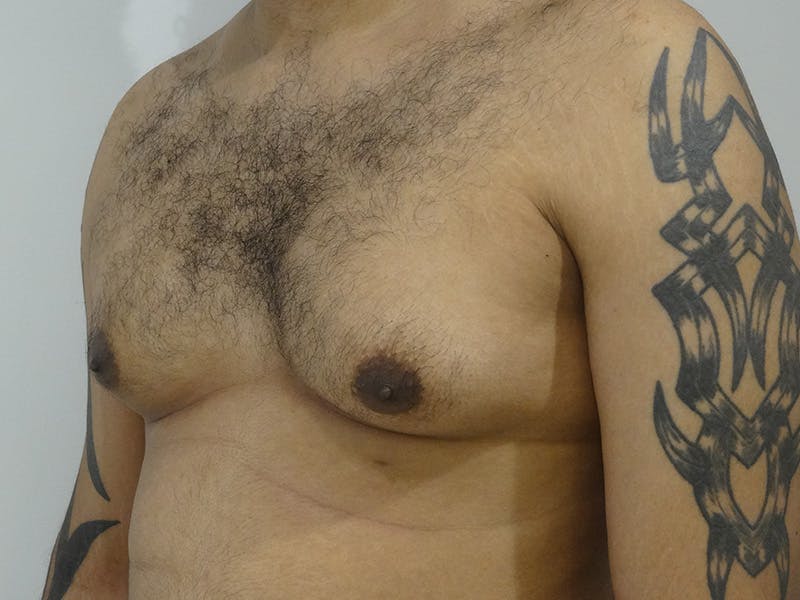 Gynecomastia Before & After Gallery - Patient 395307 - Image 3