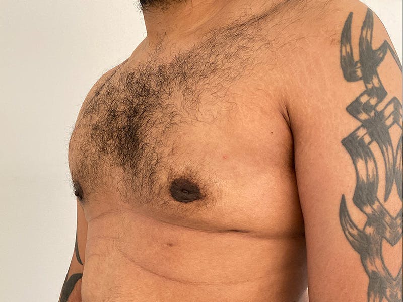 Gynecomastia Before & After Gallery - Patient 395307 - Image 4