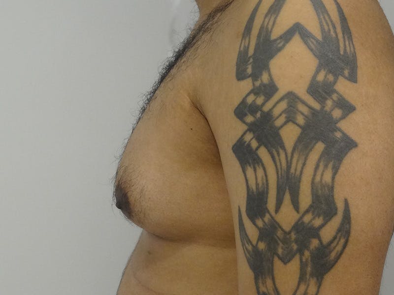 Gynecomastia Before & After Gallery - Patient 395307 - Image 5