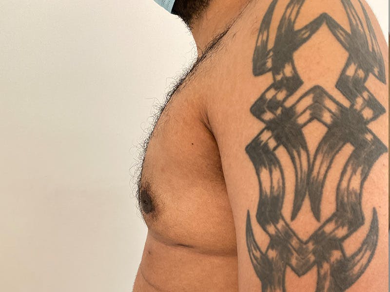 Gynecomastia Before & After Gallery - Patient 395307 - Image 6