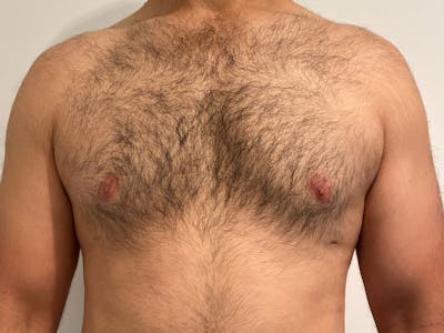 Gynecomastia Before & After Gallery - Patient 152899 - Image 2